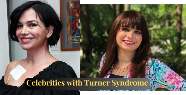 celebrities with turner syndrome